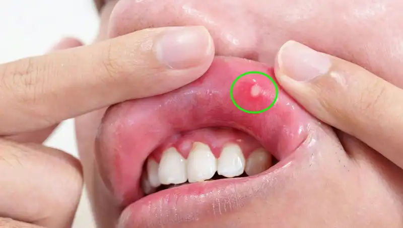 Vücut Sağlığınızı Tehdit Eden 5 B Vitamini Eksikliği Belirtisi